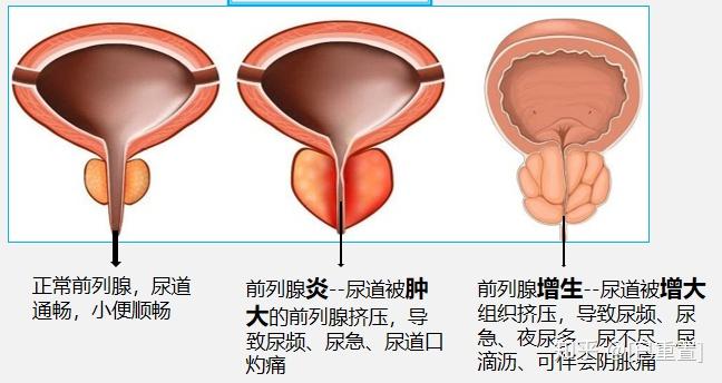 什么是前列腺炎症图片图片