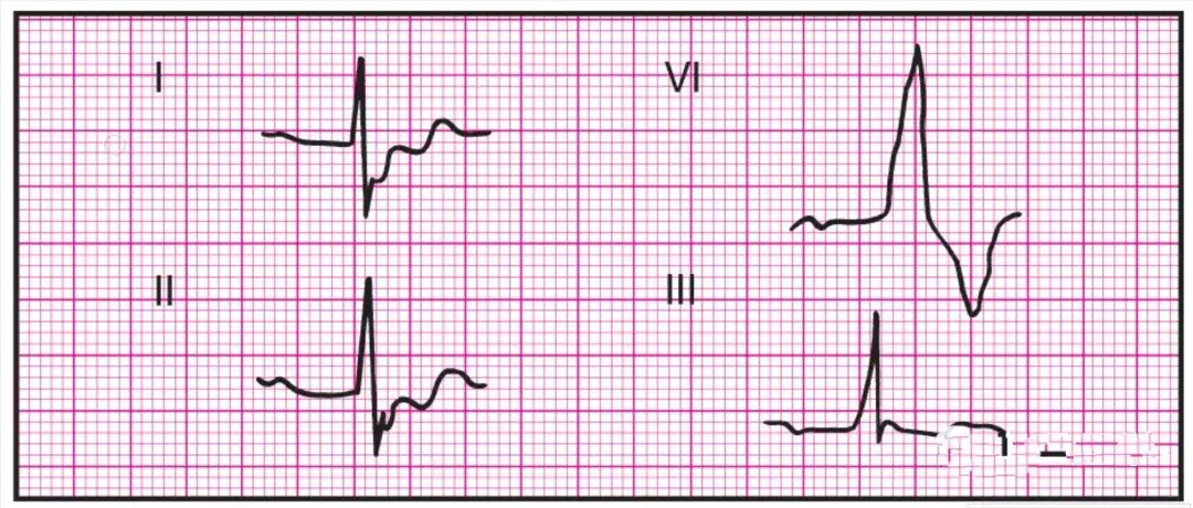 14种异常心电图的波形特点建议收藏