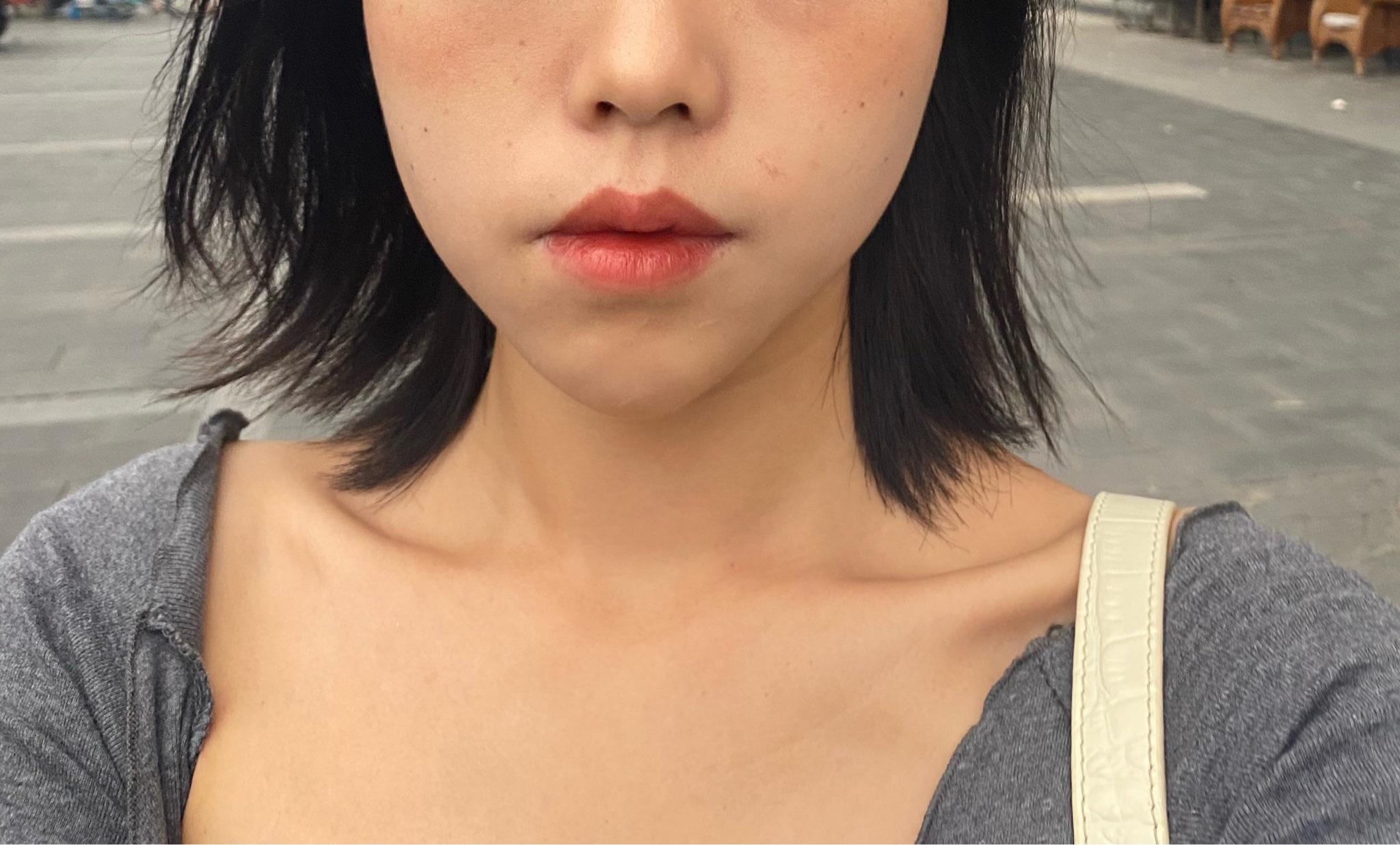 我因为下巴歪,感觉因此经常受到别人歧视,我该做手术吗?