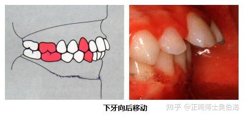 正常的牙齒排列是這個樣子看看你的是否正常