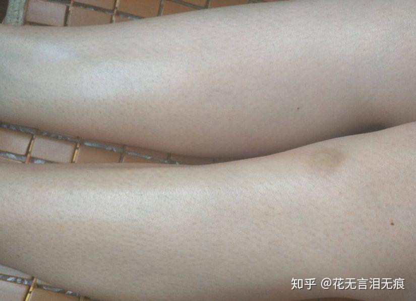 老婆鸡皮肤看着恶心(老婆有鸡皮肤会嫌弃吗)