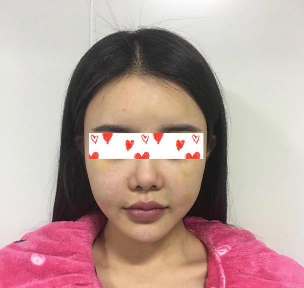 脂肪填充太多过量了怎么修复呢