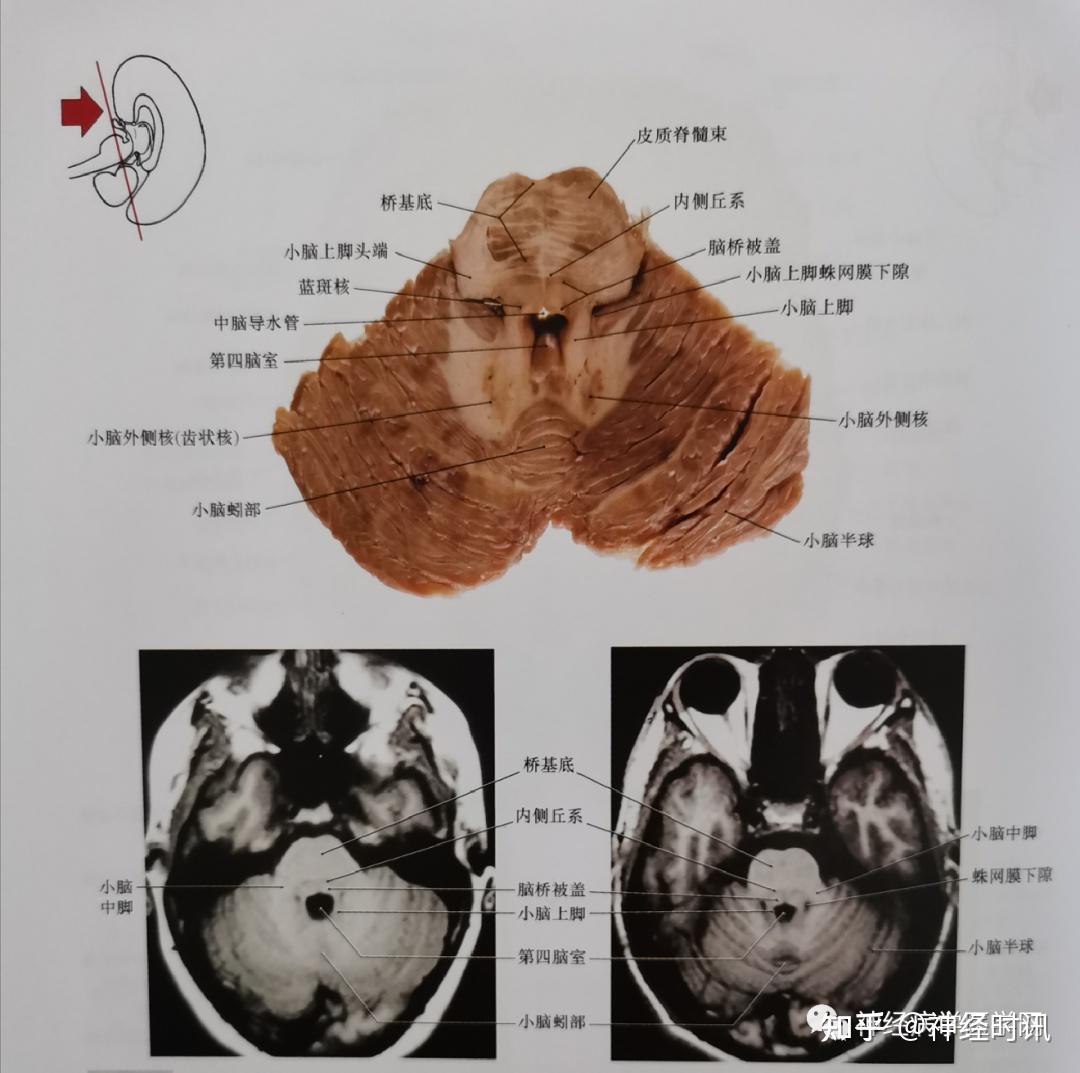临床神经解剖图谱断层影像切片