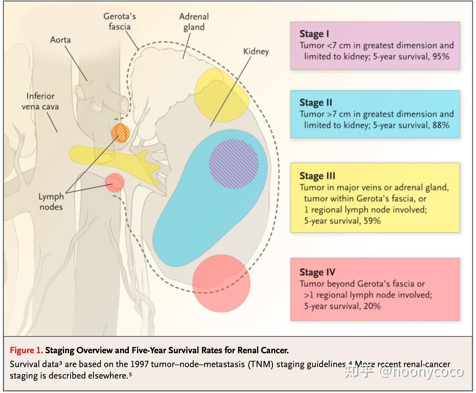 non-clear cell rcc:papillary rcc and chromosphere rccrare types