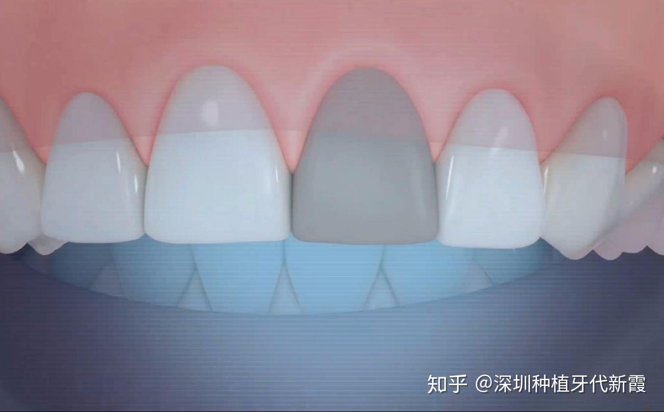 失去了牙神经后的牙会变成什么样？什么情况需要做根管治疗？_牙齿