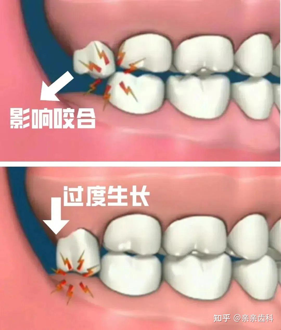 智齒反覆發炎女子臉頰爛穿一個洞備孕必看