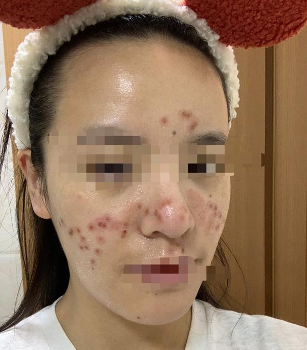 酒糟鼻激光整形历程—2021.5.21