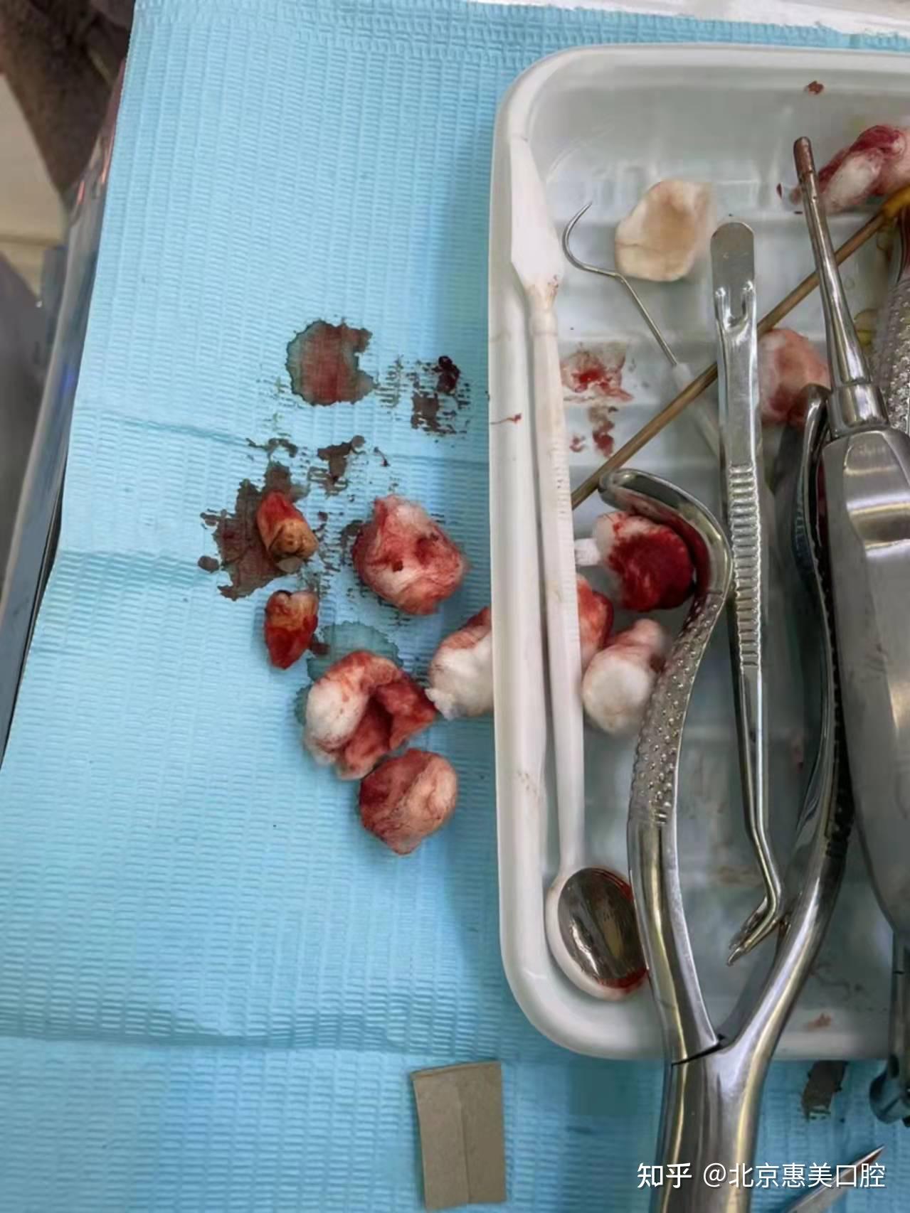 没有对邻牙等造成破坏,不影响咬合关系.