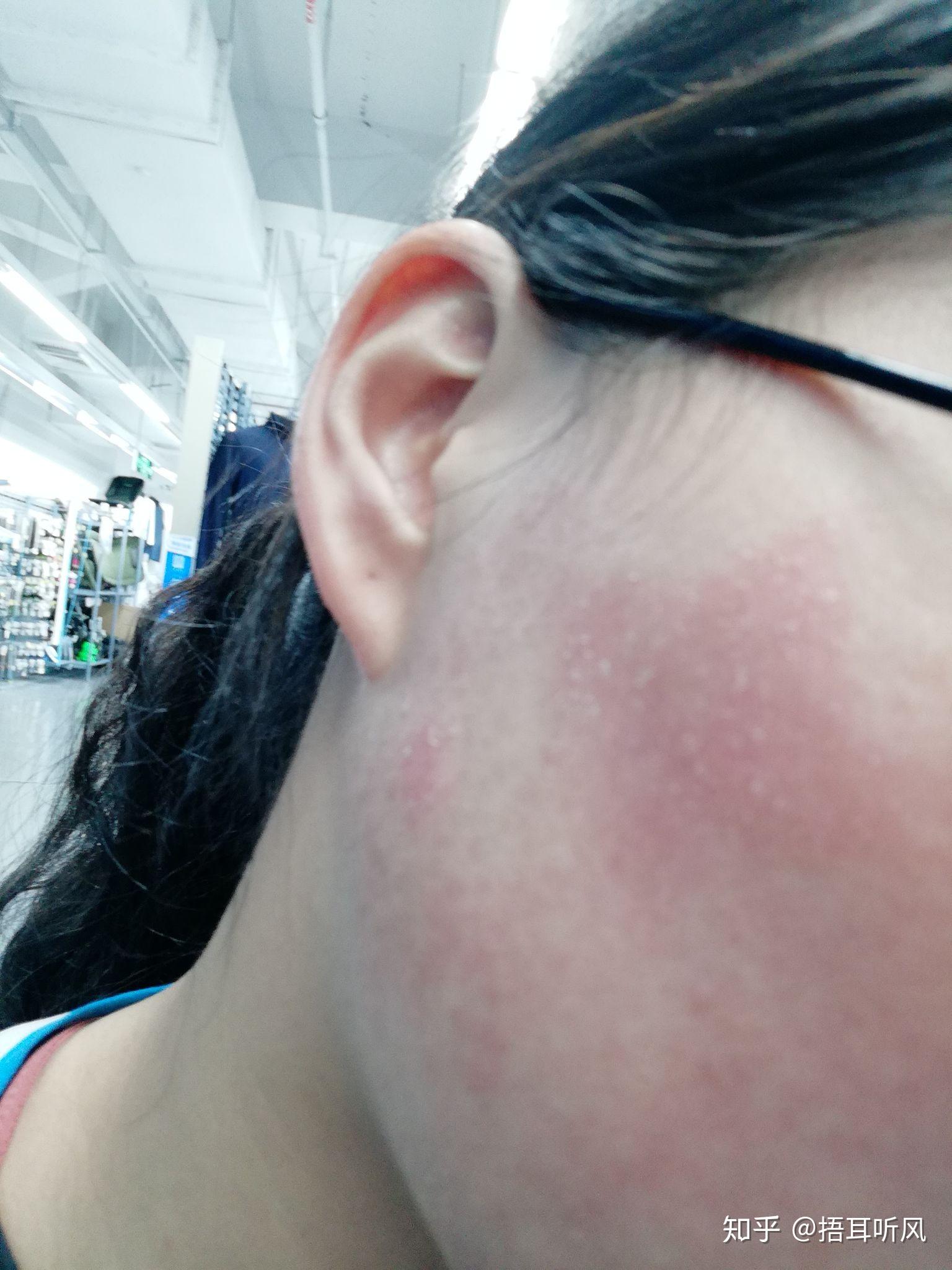 我已经过敏了两年,每年大家开心的吃龙虾的季节我就开始狂过敏,在脸部