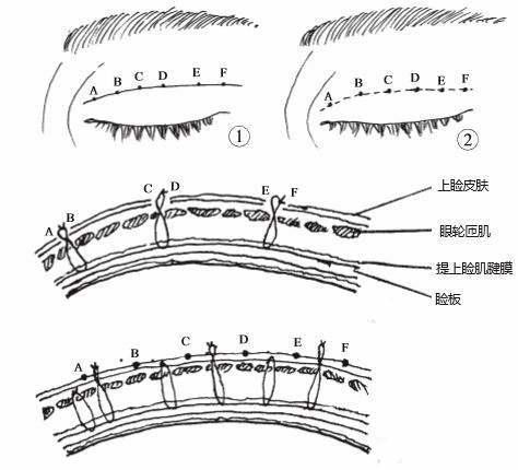 双眼皮解剖结构图解图片