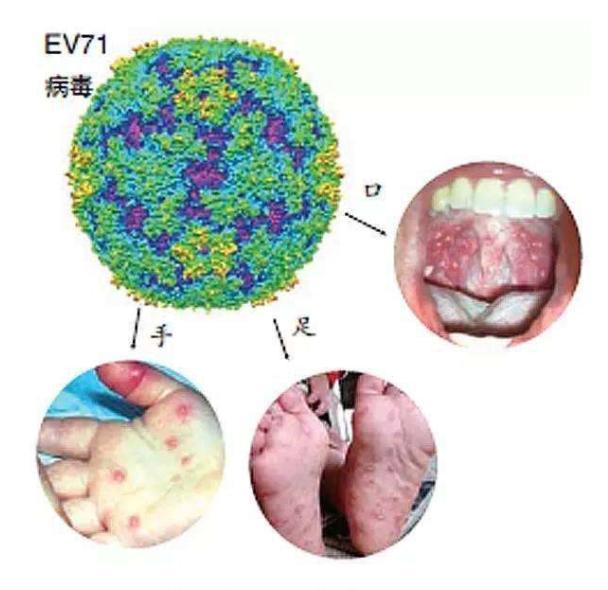 連林俊杰都中招兒的手足口到底有多可怕70個潰瘍手上長滿皰疹