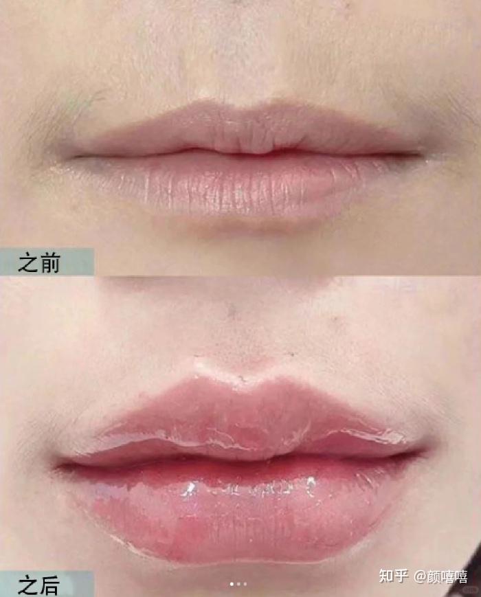 厚唇改薄,玻尿酸丰唇,m唇价格便宜吗?