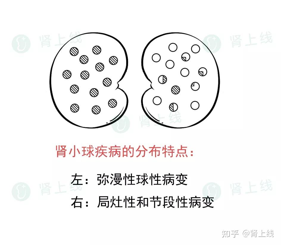 節段性病變和球性病變:節段性指的是,在腎穿刺病理光鏡下看到,一個球