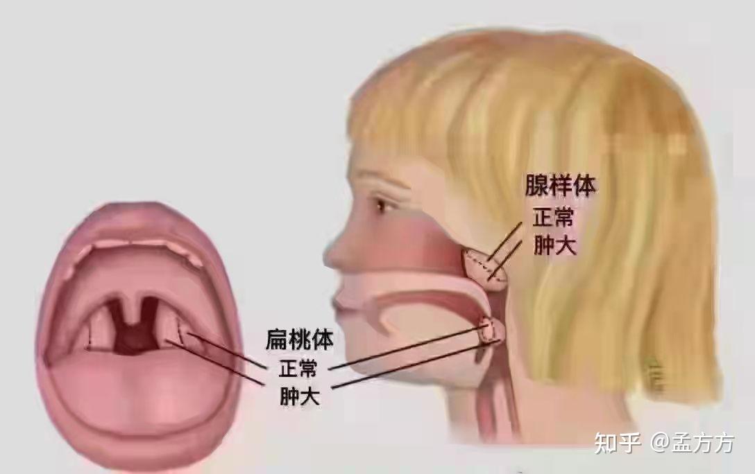 腺样体位置图图片