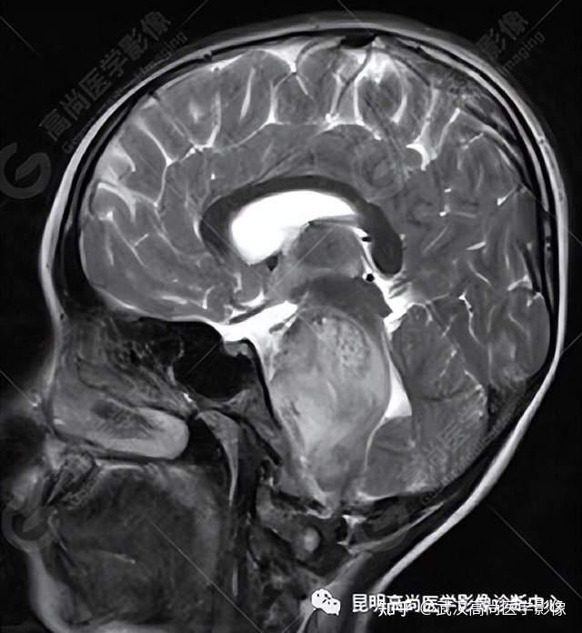 脑干弥漫性中线胶质瘤一例武汉高尚医学影像