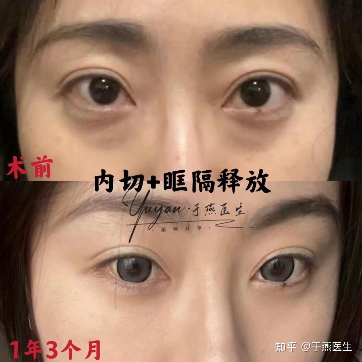 北京内路眼袋+眶隔，一年三个月追踪反馈 - 知乎