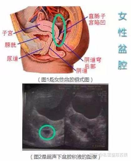 膨腔积液是什么图片