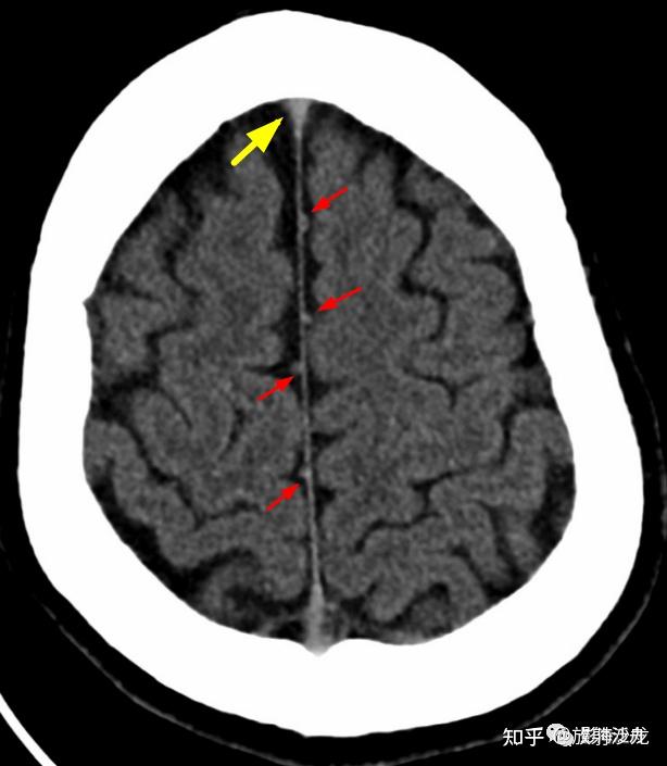 大脑镰钙化图片