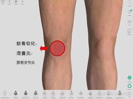 ②髕骨軟化:常發生在運動愛好者身上,通常因為力量不平衡導致下肢力線