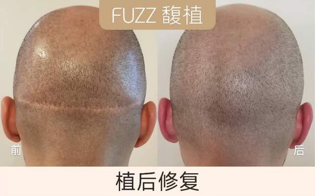 纹发是什么意思？|选择SMP纹发，这几点一定要注意 - 知乎