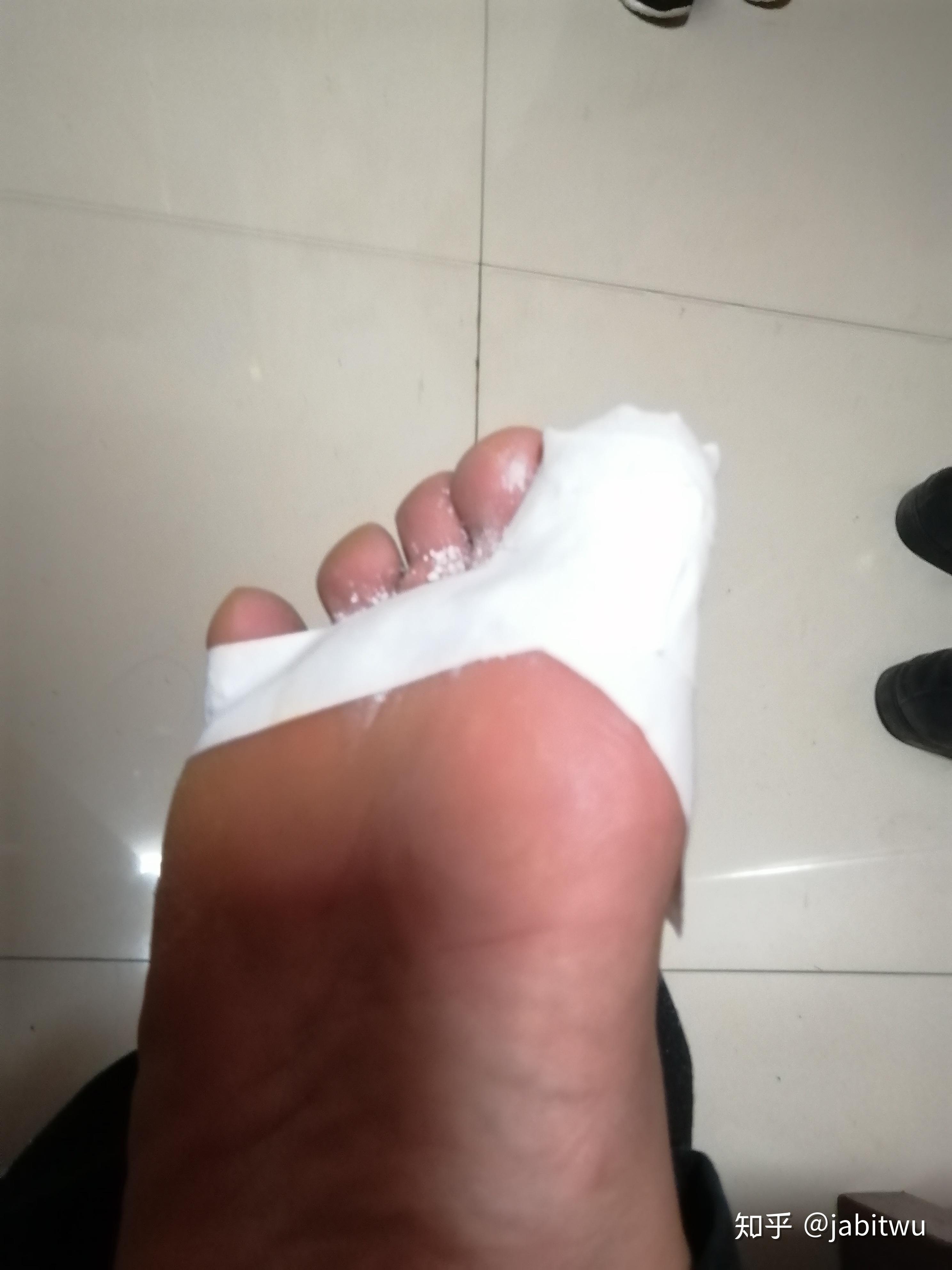 方法有效,介绍如下:以上两张就是得了三四年的跖疣,原来那血刺特别多