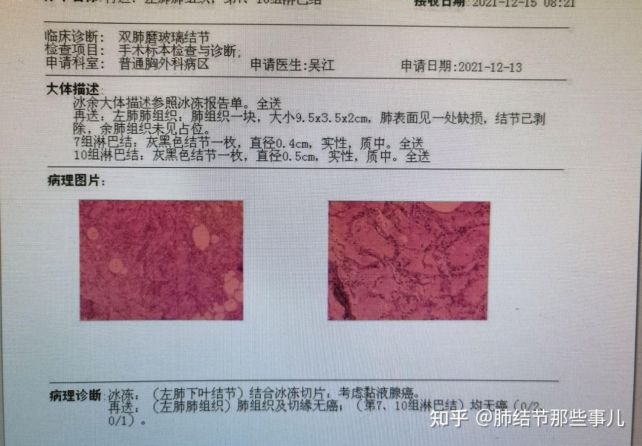 肺癌病理报告 模板图片