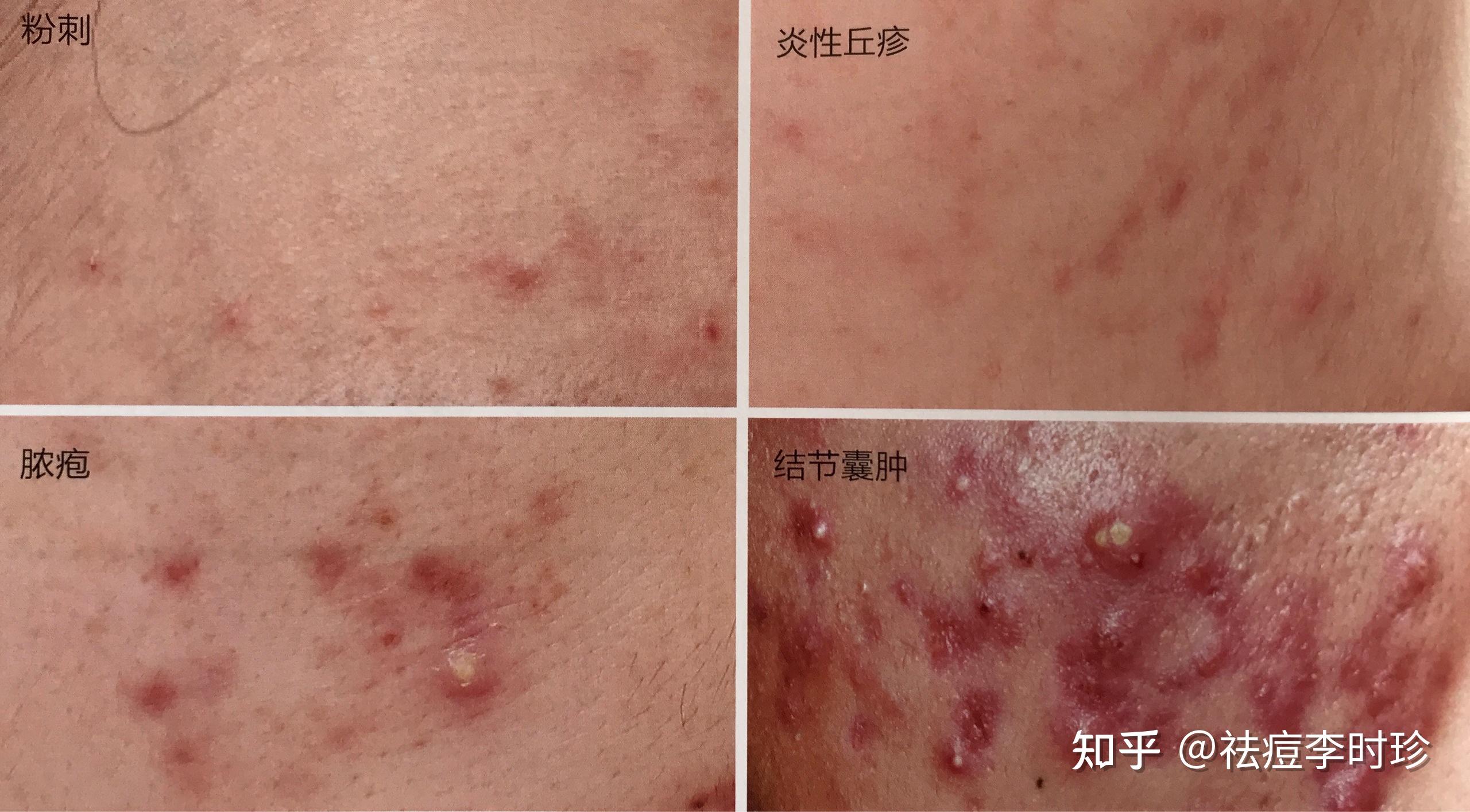 丘疹痘1:黑头粉刺,闭口痘痘可以按炎症从轻到重分为以下几种类型3