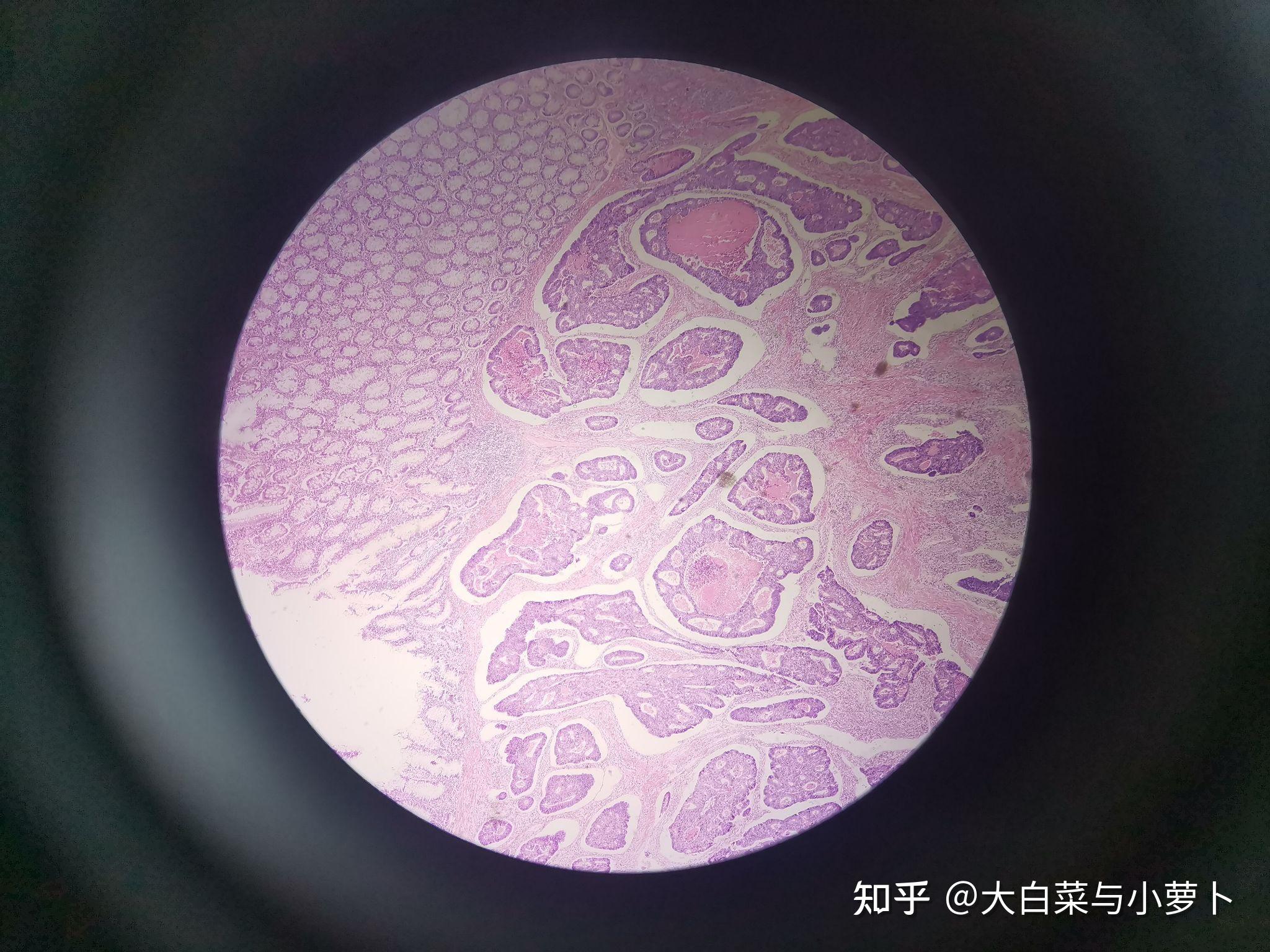 癌巢内可见鳞状细胞角化过程3高