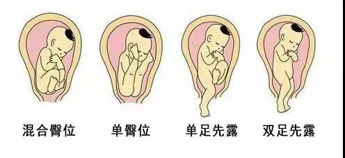 胎儿臀位——还有顺产的可能吗? - 知乎