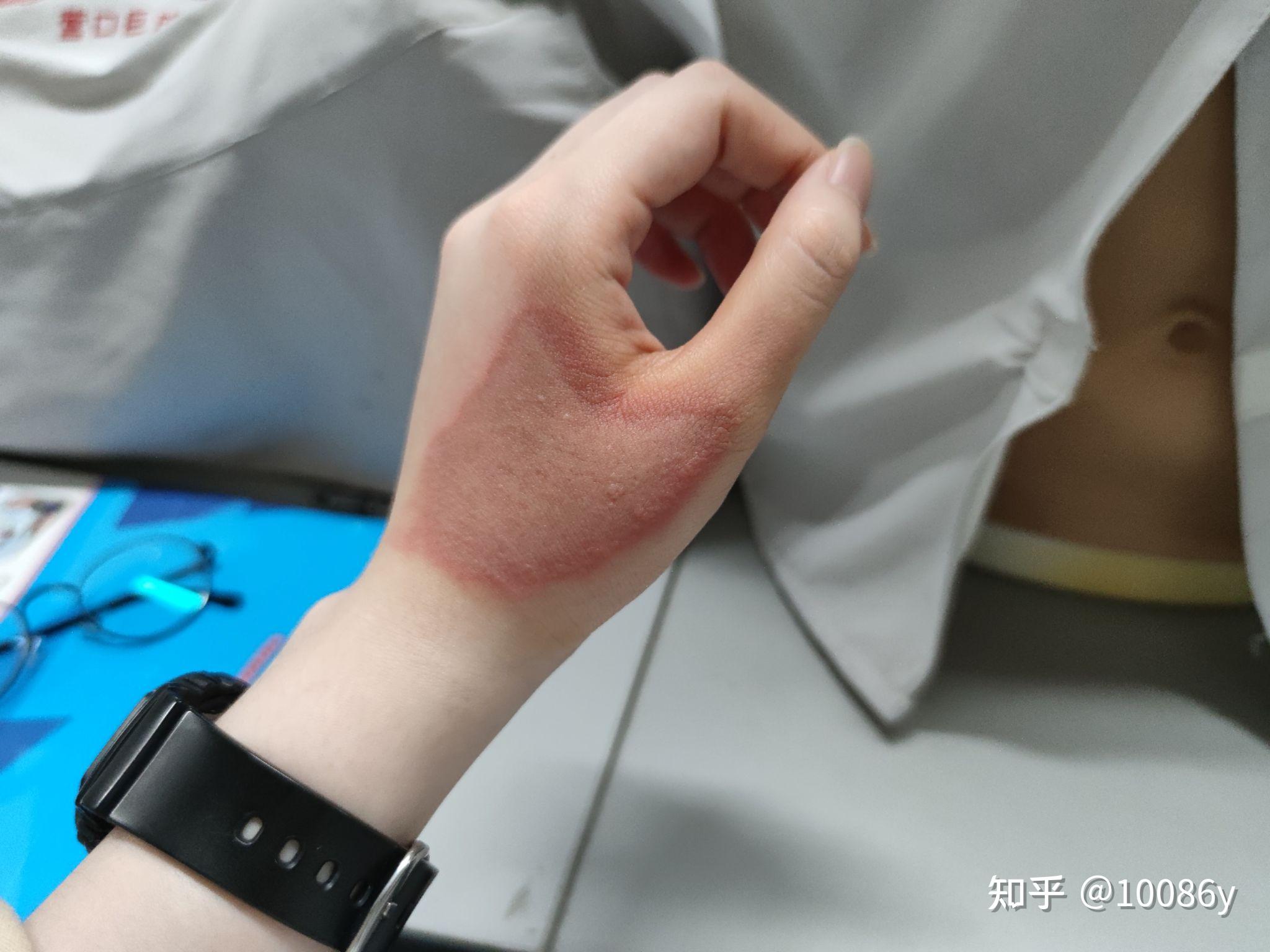 23去了医院看 医生说还好 就给我开了醋酸氯己定叫我每隔四小时擦拭一