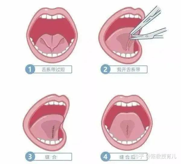 舌系带过短的问题会逐渐改善,所以,不建议切