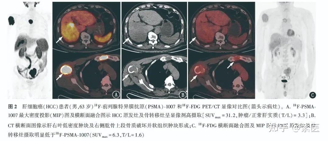 18F-PSMA-1007与18F-FDG PET/CT在初诊肝细胞癌诊断中的应用比较 - 知乎