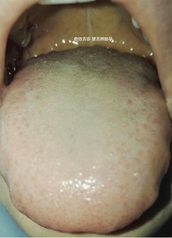 舌根与肾李芳祥奇效舌诊动画版