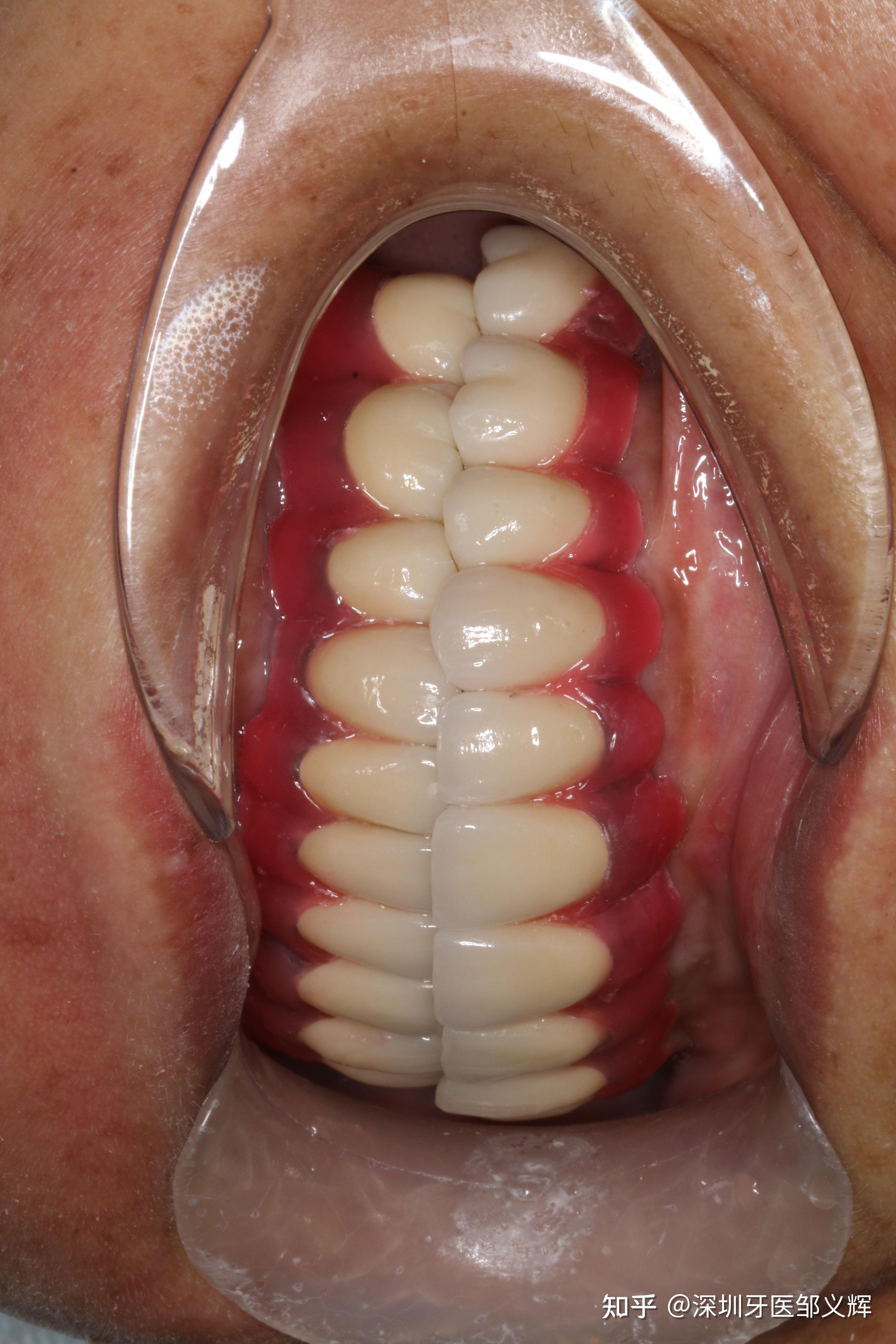 无牙颌修复一例