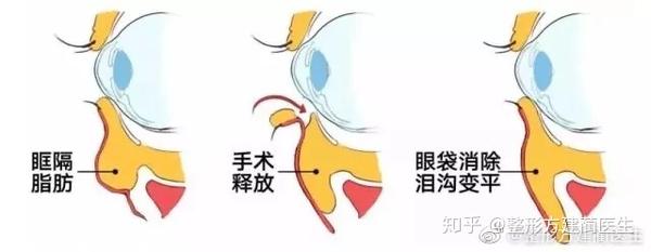 关于眶隔释放，你了解多少 - 知乎