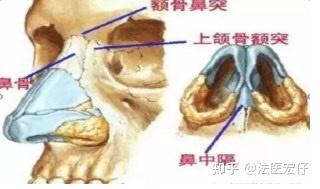 伤情鉴定实例 双侧鼻骨骨折 经笔者鉴定为轻伤二级 知乎