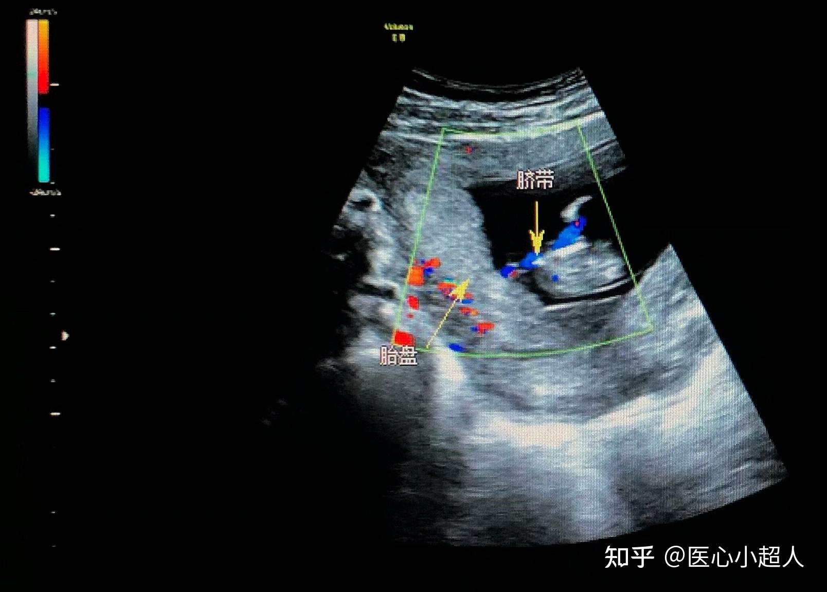 妊娠中期胎儿超声软指标-心内强回声-京东健康
