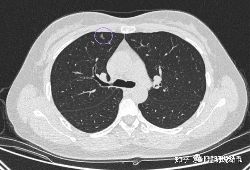 肺多發磨玻璃結節為何不主張過早干預因為猶如田徑比賽不到最後誰也知