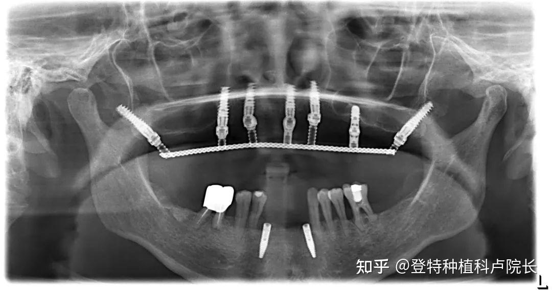 穿翼种植牙示意图图片