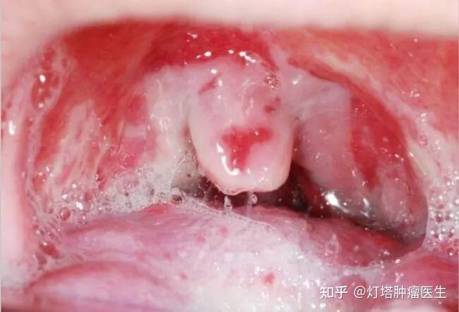 口服化疗药导致口腔黏膜炎怎么办