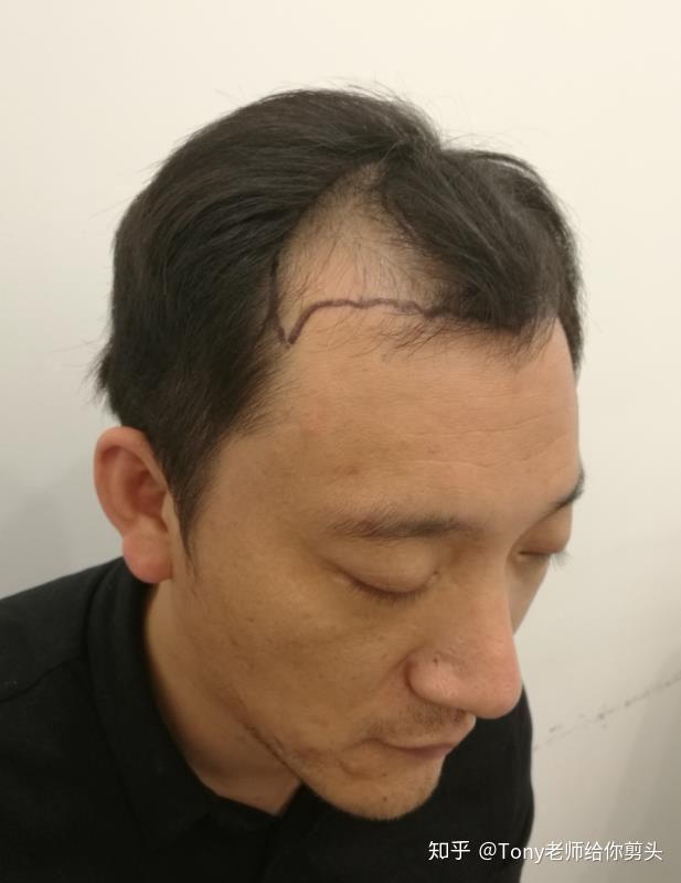 植发后男士(植发男士发际线)