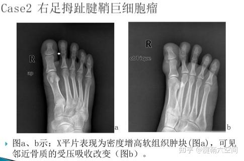 腱鞘囊腫與腱鞘鉅細胞瘤與什麼區別