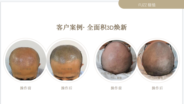 植发后有伤疤怎么修复?可以通过纹发来弥补 - 知乎