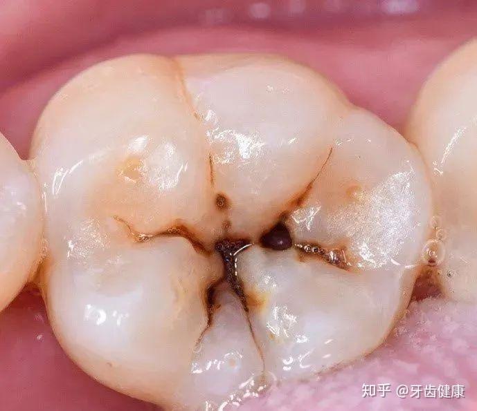 如果你的蛀牙到这种程度了,就不能靠补牙拯救了!