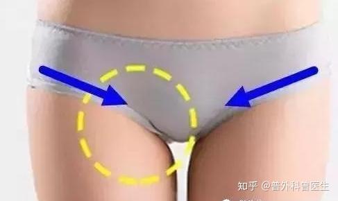 人类的腹股沟是什么地方 会得什么病 很多人都不清楚 知乎