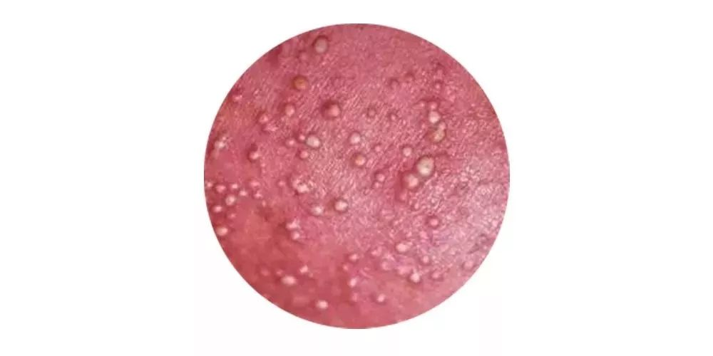 痱子有哪些类型?你知道如何区分吗? - 知乎