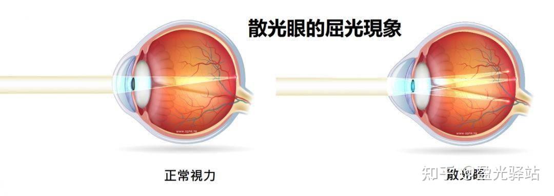 散光是怎么回事？该如何保养眼睛？ - 知乎