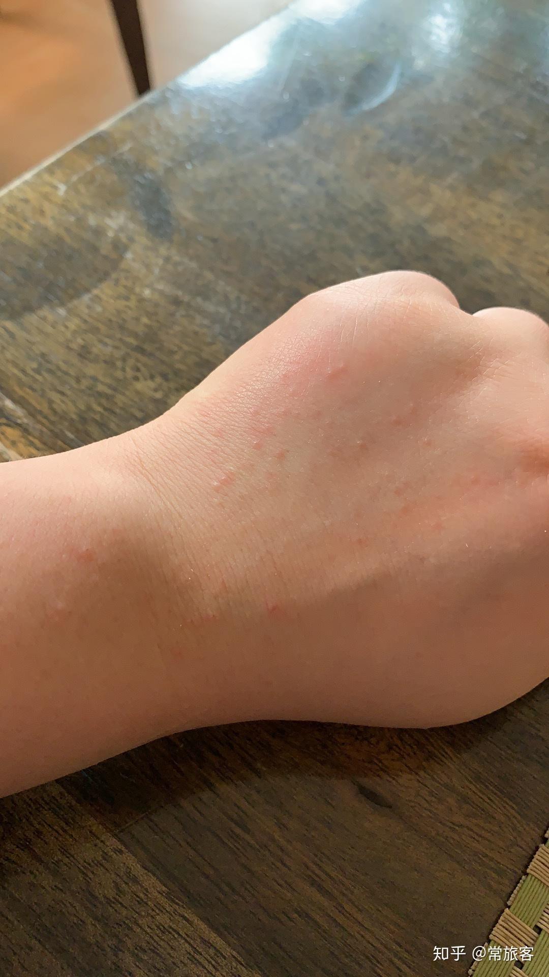 紧接当晚就出现了一些小颗粒,我怀疑自己过敏了,但没怎么在意!