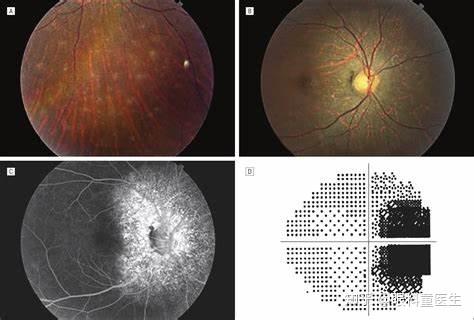 ④视野检查显示有单独或多处区域性的视野缺损③erg检查显示有视网膜