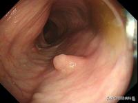 老阿姨便血以为是痔疮一查肠癌晚期为什么癌症难以早期发现